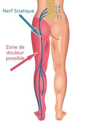 douleur sciatique