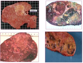 LecarcinomehepatocellulaireCHC