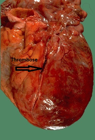 thrombose